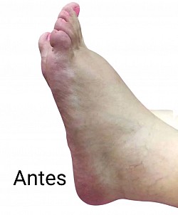 Sesión de reflexología podal - Antes